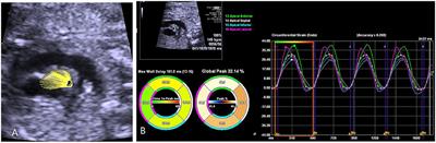 Maturation Fetus Ascending Aorta Elastic Properties: Circumferential Strain and Longitudinal Strain by Velocity Vector Imaging